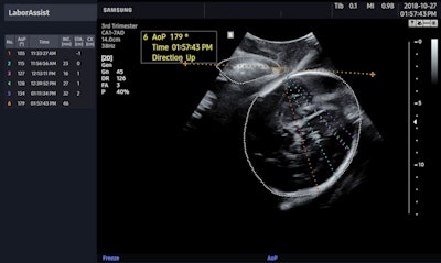 Samsung Medison's LaborAssist ultrasound image shows a fetus' angle of progression. Image courtesy of Samsung Medison.