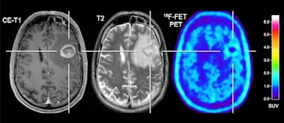 Patient with a melanoma brain metastasis pretreated with radiosurgery concurrent with nivolumab and dabrafenib in combination with trametinib. In contrast to the progressive MRI, amino acid F-18 FET-PET showed no significant uptake and was consistent with treatment-related changes. After PET imaging, the survival time was 24 months. Images courtesy of the Journal of Nuclear Medicine.