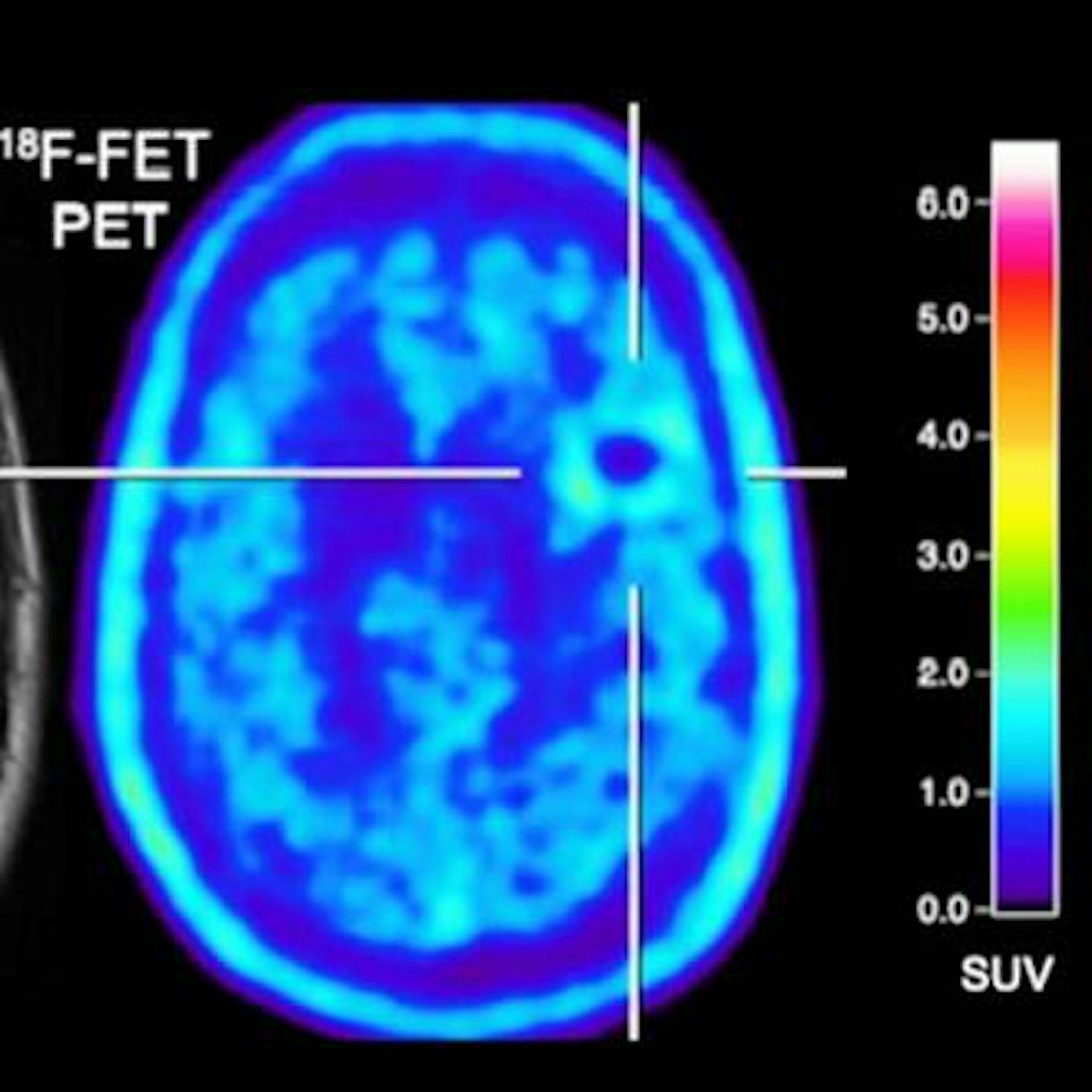 FET-PET offers more info on treatment of brain metastases | AuntMinnie