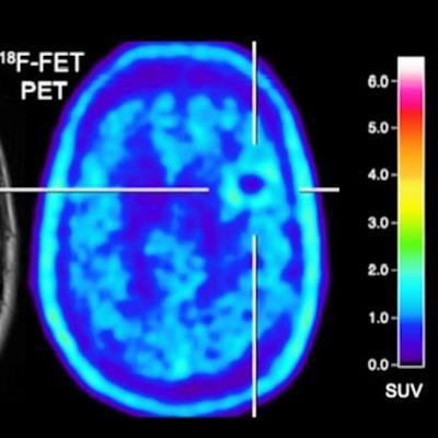 2020 09 11 23 40 2891 2020 09 14 Fet Pet Brain Metastasis Jnm 20200911230905