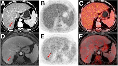Indeterminate lesion on PET/CT classified by PET/MRI for 53-year-old man with lung cancer. Contrast-enhanced CT (A), PET (B), and fused F-18 FDG PET/CT (C) images are displayed in comparison with contrast-enhanced T1-weighted MRI (D), PET, and fused F-18 FDG PET/MRI (F) images. In CT (A), hyperdense, subcentimeter liver lesion (arrows) in segment VII is suggestive of transient hepatic attenuation difference or small hemangioma. As malignancy cannot be excluded, it needs further investigation. On PET/MRI, lesion is clearly classified as metastasis because of contrast enhancement and tracer uptake due to later acquisition time point. Follow-up CT confirmed diagnosis after 78 days. Image courtesy of SNMMI.