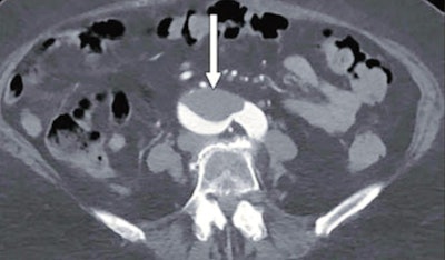76-year-old woman who presented to emergency department with upper back pain. Axial abdominopelvic CT angiogram shows nonocclusive acute aortic thrombus (arrow). Bilateral common iliac artery and left internal iliac artery thrombi (not shown) were also seen, as well as signs of chronic atherosclerotic disease. After findings of concurrently performed chest CT raised concerns, the patient was determined to have COVID-19. Images and captions courtesy of the AJR.