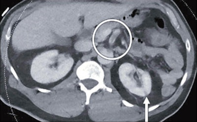 46-year-old man who was found to have COVID-19 after presenting with fever, shortness of breath, epigastric pain, and weakness. Axial contrast-enhanced abdominopelvic CT image shows small left renal infarct (arrow) and nonocclusive aortic, celiac artery, and superior mesenteric artery thrombus (circle). Complete common hepatic artery thrombus (not shown) was also seen. Splenic and renal infarctions (not shown) were present, despite patent visualized associated arteries and veins. Concurrently performed contrast-enhanced chest CT angiogram (not shown) showed lobar and segmental pulmonary emboli; probable left lower lobe pulmonary infarction rather than pneumonia; and bilateral, multilobar, patchy but confluent ground-glass opacities typical of COVID-19.