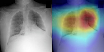 Examples of chest x-rays and the network generated heatmaps from the reader study test set. Above, left: A COVID-19 pneumonia case (64-year-old male) that was classified correctly by CV19-Net but incorrectly by all three radiologists. Above, right: The heatmap generated by CV19-Net overlaid on the original image. The red coloring highlights the anatomical regions that contribute most to the CV19-Net prediction. Below, left: A non-COVID-19 pneumonia case (58-year-old female) which was classified correctly by CV19-Net but incorrectly by all three radiologists. Below, right: The heatmap highlights the anatomical regions that contribute most to the CV19-Net prediction. Images courtesy of the RSNA.