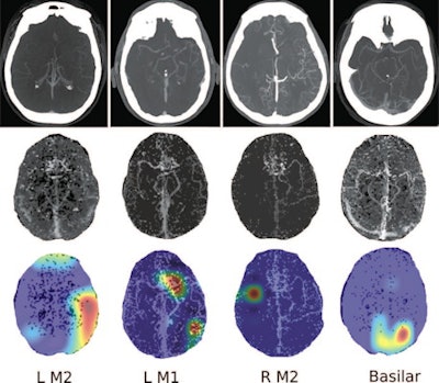 Four separate patients with large-vessel occlusions correctly predicted by the algorithm. The top row shows a representative CT slice from the delayed venous-phase CT angiography scans. The middle row shows the preprocessed maximum intensity projection images that function as the input to the model. The bottom row are overlaid heat maps, with areas in red showing the most discriminative regions. These so-called hot regions correlate with the occlusion location (respectively: left [L] M2, L M1, right [R] M2, basilar) in each patient. Images and caption courtesy of the RSNA.