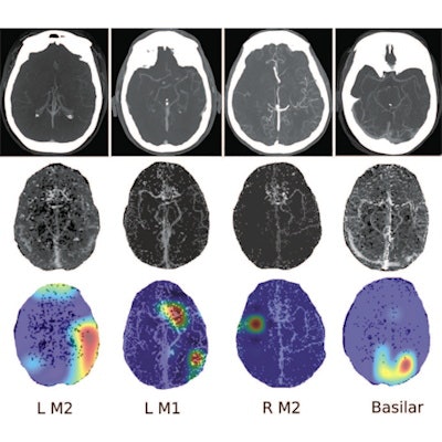 2020 09 29 16 20 8411 2020 09 29 Radiology Ai Stroke Stib