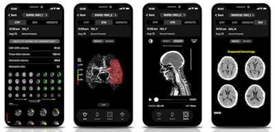 RapidAI's Rapid cerebrovascular imaging AI platform includes a range of stroke imaging and assessment applications. Images courtesy of RapidAI.