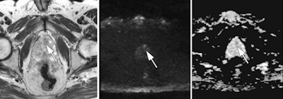 A 78-year-old man with prostate cancer undergoing active surveillance had a Gleason score of 3 + 3 = 6 (grade group 1) based on the results of a prior transrectal ultrasound-guided biopsy. Multiparametric MR images (left to right: axial T2-weighted, diffusion-weighted, and apparent diffusion coefficient ) depict a lesion (arrows) in the anterior gland at 12 to 1 o'clock that was not detected at the prior transrectal ultrasound-guided biopsy (arrows). In-bore MRI-guided biopsy was performed, resulting in a Gleason score of 3 + 4 = 7. Images and caption courtesy of the RSNA.