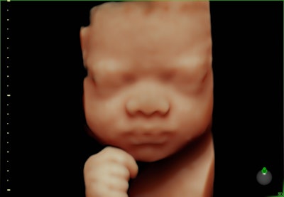 A 3D fetal image acquired with the Voluson Swift scanner. Image courtesy of GE Healthcare.