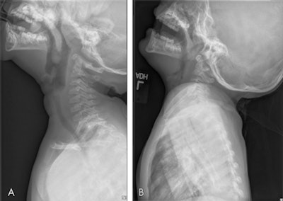 Examples of radiographic examinations ground truth, classified as (A) adequate, and (B) inadequate. The inadequate image shows poor distention of the pharynx with opposition of the palatine tonsils and adenoids and apparent thickening of the prevertebral soft tissues. The image in B is a candidate for repeat imaging. Images and caption courtesy of the RSNA.