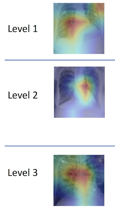 MIT's machine-learning algorithm quantifies edema on chest x-rays on a scale from 0 (normal) to 3 (alveolar edema). Image courtesy of MIT CSAIL.