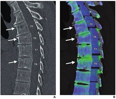 59-year-old man involved in skiing accident. (A) Sagittal reformatted bone window CT image of thoracic spine shows wedge-shaped deformity at T6 and subtle superior endplate deformities at T5 and T8. Arrows denote deformities. (B) Color-coded dual-energy CT shows only T8 deformity is associated with bone marrow edema; T5 and T6 deformities likely represent chronic fractures. Arrows denote deformities. Images and caption courtesy of the American Roentgen Ray Society.