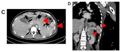 Case 2: After reporting a blunt trauma to the abdomen by her partner, abdominal CT of a 41-year-old female revealed splenic injury with parenchymal laceration (arrowheads) without intra-abdominal bleeding (C, D). The injury was treated conservatively and regularly checked by ultrasound. The bleeding stopped spontaneously. Police were informed.