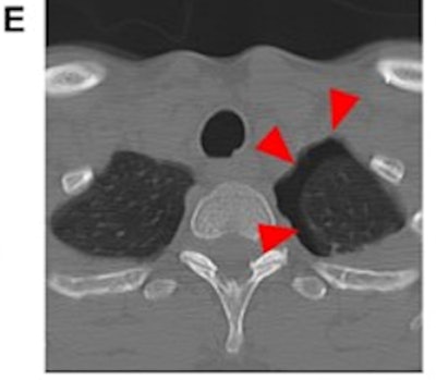 Case 3: A 49-year-old female patient was suspected to have been pushed by her partner, resulting in a fall against a bathtub. Caudal slices of a cervical spine CT showed incidental traumatic pneumothorax on the left side (arrowheads) as a result of rib fractures (not illustrated), but no pathology of the cervical spine (E). The police were informed. IPV was self-reported after questioning by medical professionals in these cases; however, we have no information on the outcomes of the police investigations on the alleged attacks.