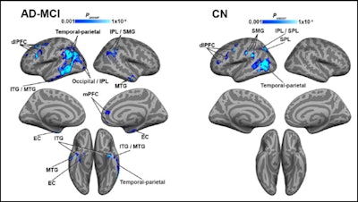 Brain regions with a negative correlation between blood flow and tau. Alzheimer's disease and mild cognitive impairment (AD-MCI) on the left, cognitively normal (CN) on the right. Image courtesy of Albrecht et al and the Journal of Neuroscience.
