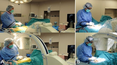 (A) The surgeon views the standard fluoroscopic monitor by turning the head away from the surgical field. (B) The surgeon uses the smart glasses display device as an alternative method to display fluoroscopic images, and so the surgeon's focus can be maintained on the surgical field. Image courtesy the American Association of Neurological Surgeons.