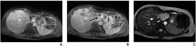 A 56-year-old woman with benign hemangioma. Lesion was originally reported as indeterminate enhancing mass, and outside report recommended biopsy. Classic features of benign hemangioma are shown. Error was attributed to faulty reasoning. (A) Axial MR image obtained five minutes after contrast agent administration shows peripheral nodular discontinuous enhancement. (B) Axial MR image obtained 10 minutes after contrast agent administration shows centripetal progression of enhancement (arrow). (C) Axial fast imaging employing steady-state acquisition (FIESTA) MR image shows lesion is homogeneously hyperintense compared with liver parenchyma. Images and caption courtesy of the ARRS.