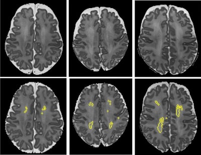 MRI scans showing diffuse white-matter abnormality. The top three panels display raw MRI images from very preterm infants born at 27 weeks (left), 26 weeks (center), and 31 weeks (right) of gestation. Higher signal intensity can be seen in the central white matter, particularly for the 31-week-gestation infant. The bottom panels display the corresponding slices with objectively segmented DWMA in yellow. The 27-week infant (left) was diagnosed with mild DWMA, the 26-week infant (center) was diagnosed with moderate DWMA, and the 31-week infant had severe DWMA. Image and caption courtesy of Cincinnati Children's and Scientific Reports.