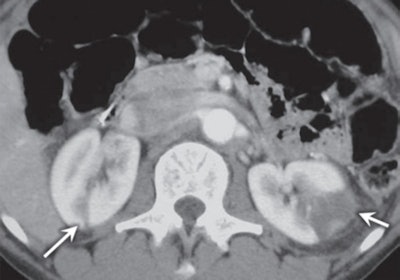 Renal infarcts after cocaine use in a 34-year-old man who presented to the emergency department with sudden-onset flank pain. Axial contrast-enhanced CT image of the abdomen shows wedged-shaped peripheral areas of decreased enhancement (arrows), representing bilateral renal infarcts. Images courtesy of RadioGraphics.