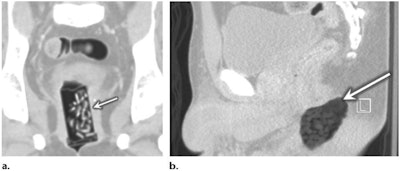 'Body pushing' in two patients. (a) CT image of the pelvis with lung windows in a 40-year-old woman who was hit by a car shows a cylindrical container in the vagina with ovoid opacities representing prescription opiate pills (arrow). (b) Sagittal CT image of the pelvis in a 28-year-old man shows a foreign body in the rectum (arrow), which was then extracted and confirmed to be a bag of marijuana.