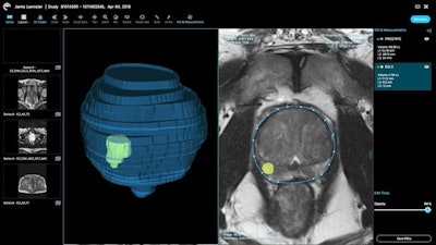 Ezra's AI software provides prostate and lesion segmentation on MRI. Image courtesy of Ezra.