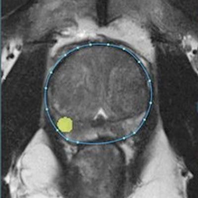 2020 10 20 18 29 1638 2020 10 20 Ezra 3 D Prostate Lesion Ai 20201020184140