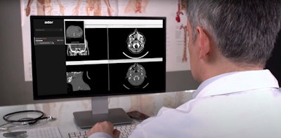 Aidoc's new AI algorithm provides flagging and notification of incidental pulmonary embolism found on CT scans. Image courtesy of Aidoc.