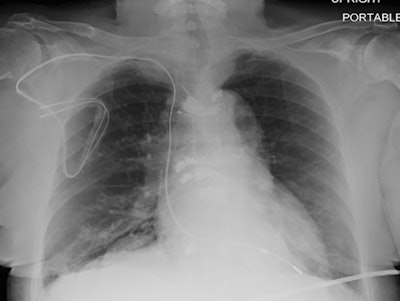 Chest radiograph, posteroanterior view, in a 64-year-old woman with a history of heart transplantation demonstrates retained portion of right ventricular pacing lead and defibrillator lead with superior vena cava coil. The patient underwent five MRI examinations through a prospective registry study. Image courtesy of the Radiological Society of North America.