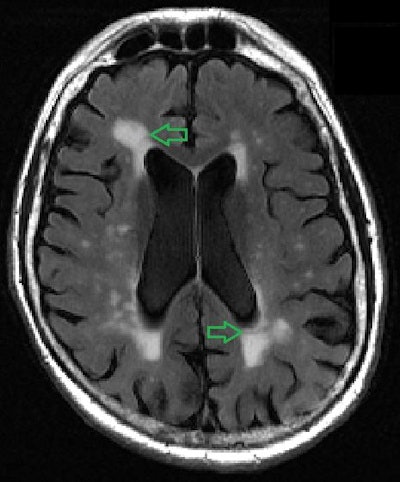 MRI image of human brain shows multiple bright spots (white-matter hyperintensities) in center (as shown by green arrows). Images and caption courtesy of Academic Radiology.