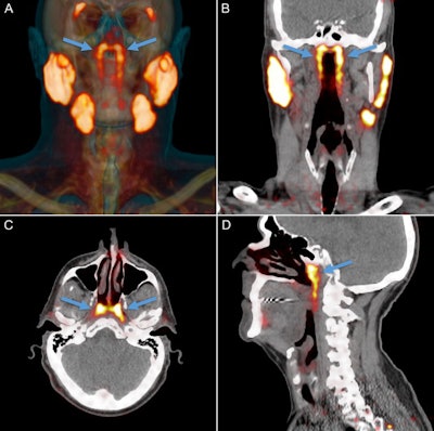 PSMA-PET projected as orange signal on reference CT. The parotid, submandibular, and sublingual salivary glands abundantly express PSMA. An unknown structure in the nasopharynx showed similar imaging characteristics (arrows). Location and extent of the tubarial glands in a random patient. Shown are coronal (B), axial (C), and sagittal (D) slices at the level of the torus tubarius of PSMA-PET projected as yellow signal on grayscale CT. The glandular structure is visible as PSMA-positive tissue (arrows). The coronal slices also show some parts of the parotid and submandibular glands, which demonstrate similar imaging characteristics. All images courtesy of Valstar et al. Licensed under CC BY-NC 4.0.