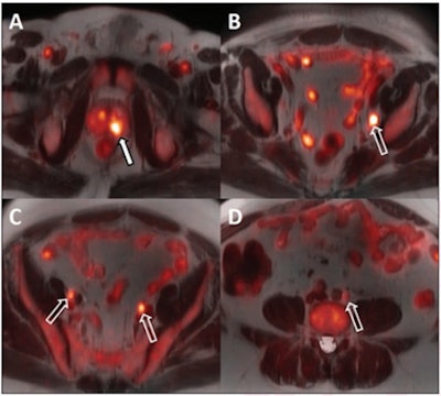 A 64-year-old man with biopsy-proven cancer rated as Gleason 4+5 in the left base and serum prostate-specific antigen of 11.1 ng/mL and equivocal conventional staging with 1.3-cm (borderline enlarged) left internal iliac lymph node. Fused F-18 fluciclovine PET/MR images demonstrate high focal uptake within the left prostate base (A, solid arrow) and left internal iliac lymph node (B, open arrow), as well as additional subcentimeter bilateral external iliac (C, open arrows) and left common iliac lymph nodes (D, open arrow) suspicious for metastatic disease. Images and caption courtesy of the American Journal of Roentgenology.