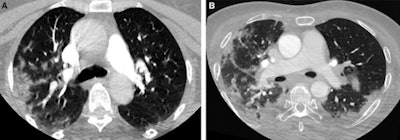 Axial CT images from head and neck CT angiography demonstrate (A) predominantly unilateral peripheral patchy ground-glass opacities, highly suspicious for COVID-19 pneumonia and (B) bilateral and multifocal, predominantly peripheral ground-glass opacities, with subpleural consolidations abutting the visceral pleura, with additional linear opacities, very highly suspicious for COVID-19 pneumonia. Images courtesy of Stroke.