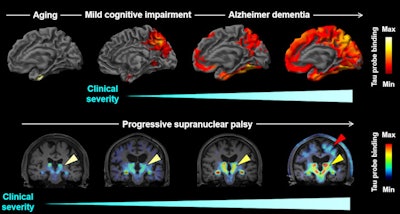 A new PET radiotracer for tau pathologies is showing promise for helping diagnose and differentiate Alzheimer's disease (AD) from a wide range of other dementia disorders.