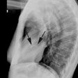 Cxr Lat