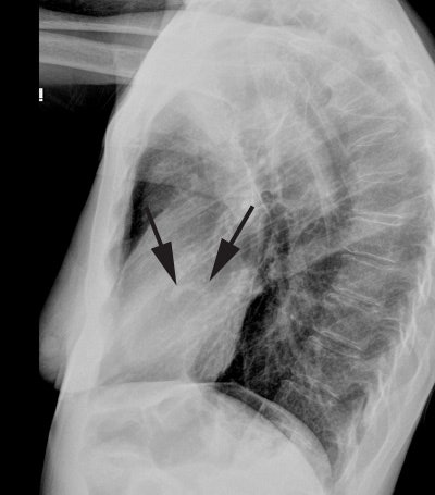 Cxr Lat