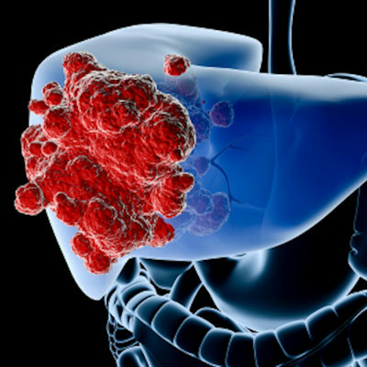 Coding and documentation for Y-90 radioembolization