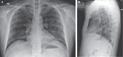 Chest x-ray of one of the first COVID-19 patients in China. Image courtesy of the New England Journal of Medicine. © 2020.