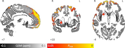 Images show area of significantly higher iron concentration in the brains of Parkinson's disease patients, compared with healthy controls. Whole-brain results are overlaid onto the quantitative susceptibility mapping template in the Montreal Neurological Institute (MNI) coordinate system. Red/yellow clusters represent statistically significant differences, as indicated by the color bar. Numbers represent position of slice in millimeters in MNI coordinate space. FDR = false discovery rate. Images courtesy of Journal of Neurology, Neurosurgery, and Psychiatry.