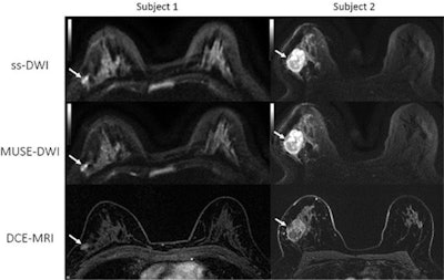Comparison of single-shot (ss) DWI, MUSE DWI, and dynamic contrasted-enhanced (DCE) MRI axial images for two patients with biopsy-proven invasive ductal carcinoma. Image courtesy of the RSNA.