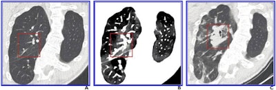 A 41-year-old autistic woman with major scoliosis and COVID-19. (A) Initial conventional axial CT image shows no noticeable lung damage (within red box) in right upper lobe. (B) Electron-density spectral CT image obtained at the same time as image A shows lesions (within red box) in the right upper lobe. (C) Follow-up conventional axial chest CT image obtained five days after images A and B confirms the presence of lesions (within red box) in the right upper lobe. Images and caption courtesy of the ARRS.