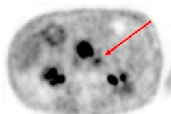2020 10 29 22 40 7384 2020 11 02 Ga68 Fapi Pet Ct Pdac Jnm 400