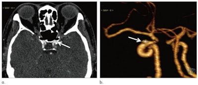 An AI algorithm was helpful for improving the detection of cerebral aneurysms on CT angiography images, though there were some limitations. In a 54-year-old woman, an aneurysm was missed, possibly because of its small size (3 mm) and location near the skull base. Image courtesy of Radiology.