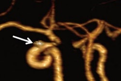 2020 11 02 23 36 2729 2020 11 03 Long Cta Aneurysm Figure4 20201102235731