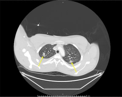 The arrows illustrate bilateral pulmonary infiltrates on a chest CT scan with contrast. Images courtesy of Keshary et al. Licensed under CC BY-NC 4.0.