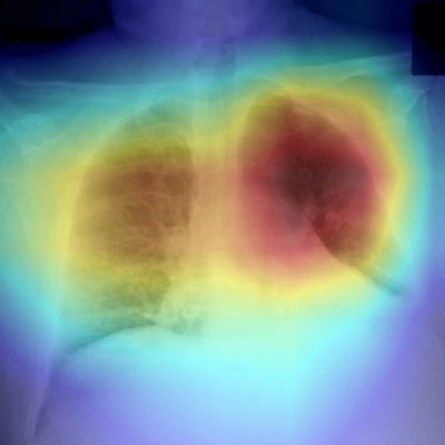 Image shows heatmap generated by CV19-Net overlaid on original image. Red area highlights regions that contribute most to the CV19-Net prediction. Image courtesy of the RSNA