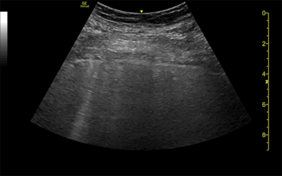 Ultrasound and CT images from a 62-year-old woman with long-term COVID-19 symptoms. The patient, who was not part of the study, visited the Madrid emergency department with persistent dyspnea and cough. The ultrasound image (above) shows an irregular pleural line and some B-lines, which correlate to ground-glass opacities in the lower lobes on CT (below). Images courtesy of Dr. Yale Tung-Chen, PhD.
