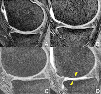 MR images of the right knee (A, B, C, D) at baseline (A, C) and after 48 months (B, D). An overweight 47-year-old woman in the elliptical trainer group (A-B) and an overweight 64-year-old man in the racket sports group (C-D). The man in the racket sports group developed severe cartilage damage at the femur and tibia bones (arrowheads). In contrast, no cartilage damage was seen in the woman in the elliptical trainer group (A-B). Images and caption courtesy of the Radiological Society of North America.