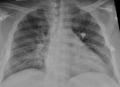 Chest x-ray of a SARS-CoV-2-positive patient exhibiting confusion and showing weakness on his left side shows pneumonia in the lower lungs. Image and caption courtesy of the RSNA.