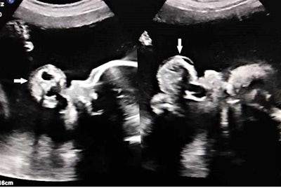 Ultrasound shows an elongated stalk of tissue with a polypoidal mass protruding from the mouth of the fetus and floating in the amniotic cavity. The mass has mixed solid-cystic tissue layers with areas of calcifications and minimal vascularity. All images courtesy of Narayan et al. Licensed under CC BY-NC 4.0.