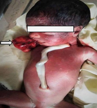 The fetus and mass protruding from the oral cavity.